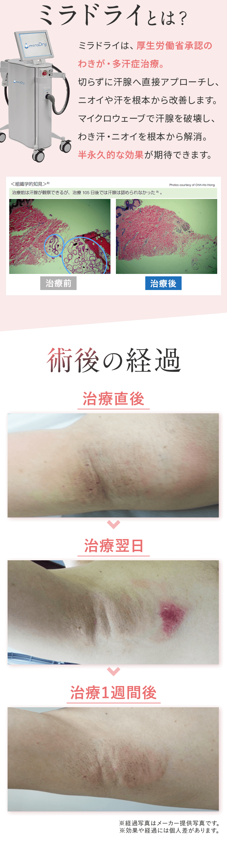 ミラドライとは？