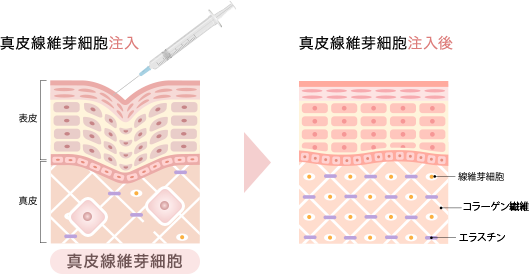 真皮線維芽細胞移植術（自家培養）の特徴・効果