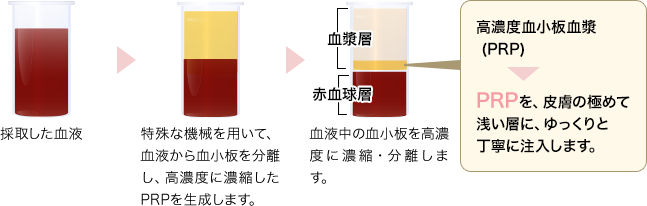 PRP（多血小板血漿）皮膚再生療法とは