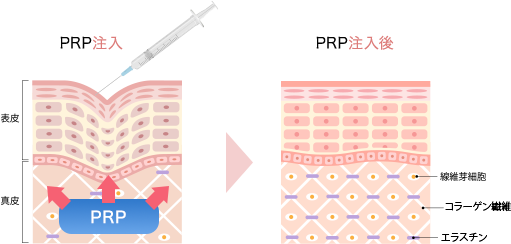 PRP（多血小板血漿）皮膚再生療法とは